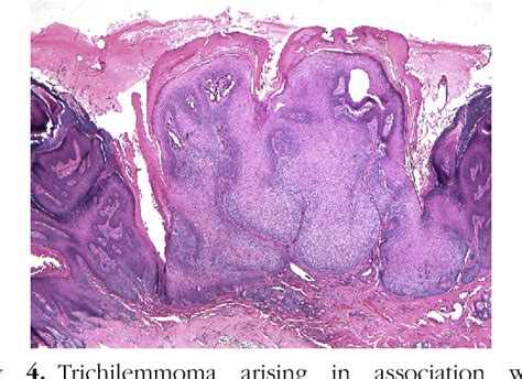 Trichoepithelioma | Semantic Scholar