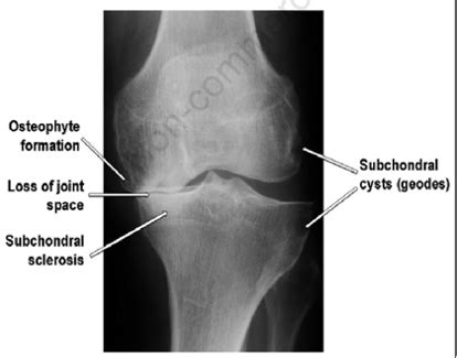 Osteoarthritis Flashcards Quizlet