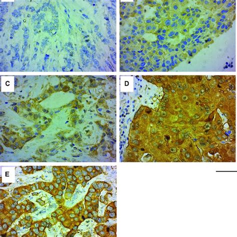 Grb7 Expression And Localization In Invasive Ductal Carcinoma Idc Of