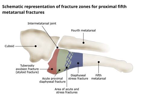 Case Report: Fifth Metatarsal Fracture - Sports Medicine Review