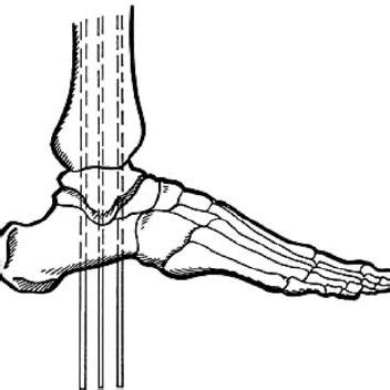 PDF Limb Salvage Reconstruction Of The Ankle With Fusion And