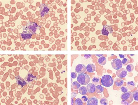 Chronic Neutrophilic Leukemia Khoder American Journal Of