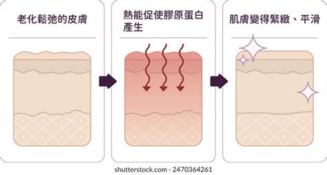 80 Thermage treatment 图片库存照片3D 物体和矢量图 Shutterstock