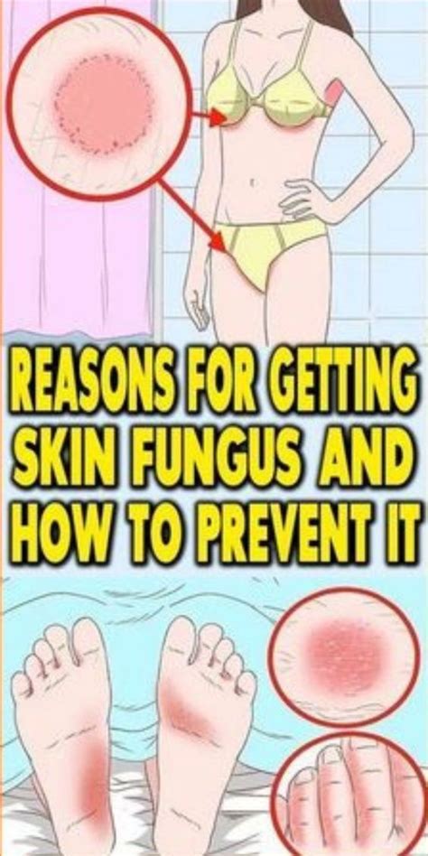 Causes of skin fungus and how to prevent it – Natural Health Care