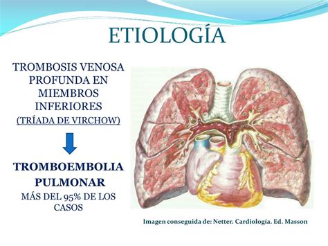 Ppt Esclerosis Vascular Embolia Pulmonar Hipertensión Pulmonar Edema Pulmonar Powerpoint