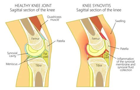 Synovitis Of The Knee Joint Inflammation Orthopedic Knee Specialist