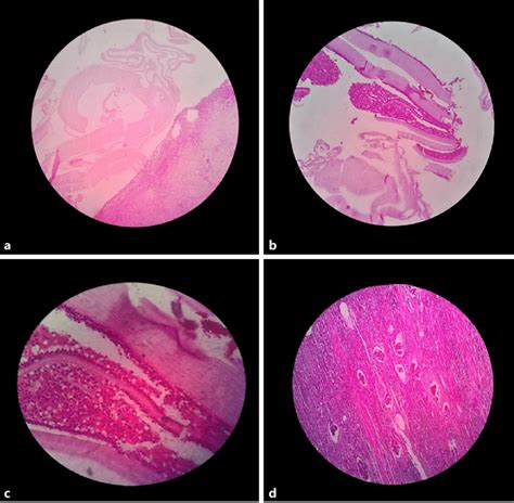 Histopathological Overview Of The Renal Hydatid Cyst A Low Power View Download Scientific