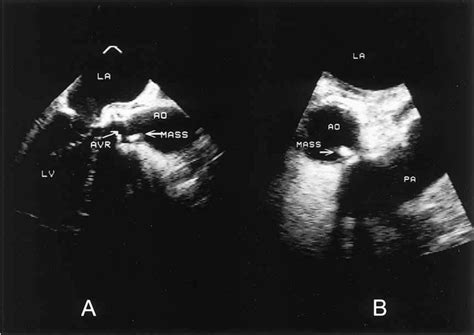 Figure 2 From Prosthetic Valve Endocarditis Due To Vancomycin Resistant