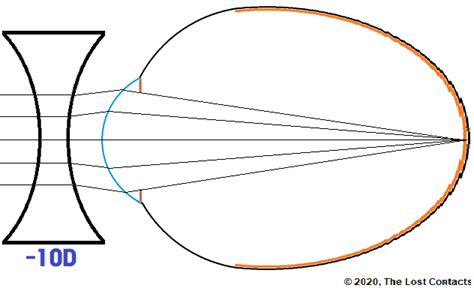 The Optics of Vision - Lesson 6: Emmetropia & Myopia - The Lost Contacts