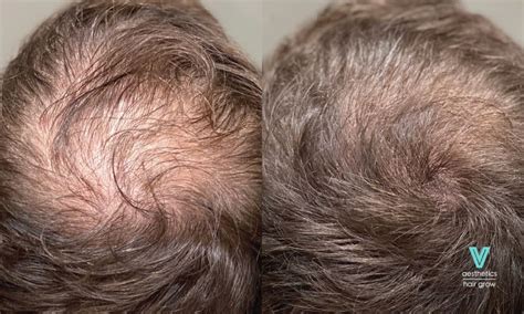 V Magic Hair Grow | Hair Growth Treatment in Singapore