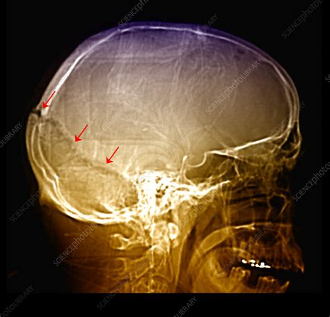 Enhanced Skull Fracture on X-Ray - Stock Image - C027/1706 - Science Photo Library