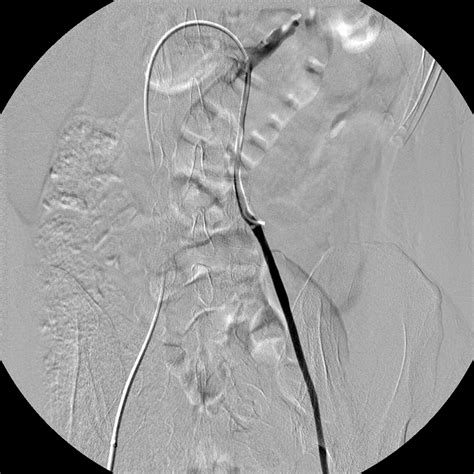 Venous Embolization Case Albany Ir