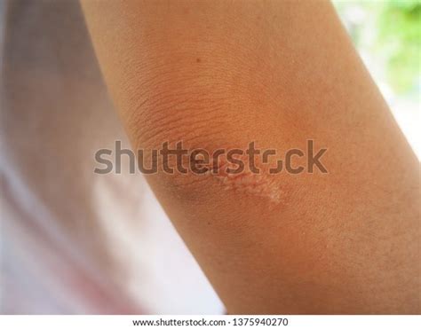 Keloid Scar Hypertrophic Scar Elbow Skin Stock Photo 1375940270