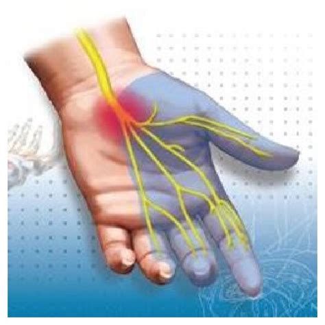 Graphical representation of the carpal tunnel with the presence of the ...