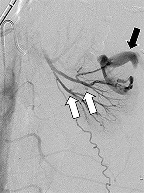 The Renal Vasculature What The Radiologist Needs To Know Radiographics