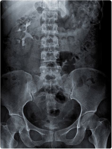 KUB Radiography