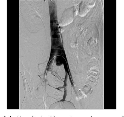 Figure 2 From Conservative Management Of A Traumatic Common Iliac Venous Pseudoaneurysm A Case