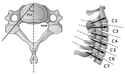 Anatomical Considerations For A Subaxial Cervical Pedicle Screw A Download Scientific