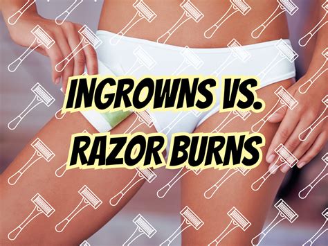 Understanding Ingrown Hair vs. Razor Burns: Differences, Causes, and ...