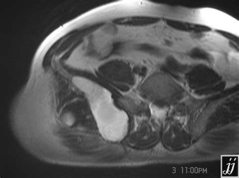 Right Gluteal Region Abscess Radiopaedia