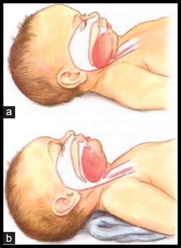 Peds Respiratory Flashcards Quizlet