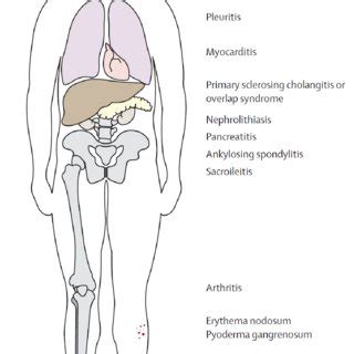 Common Extraintestinal Manifestations Of Ibd The Figure And Legends