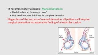 Testicular Torsion - Pediatrics Surgery