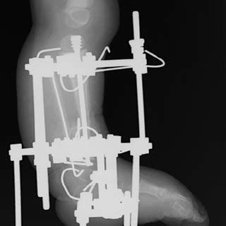 e. Lateral of the tibia after surgery. | Download Scientific Diagram