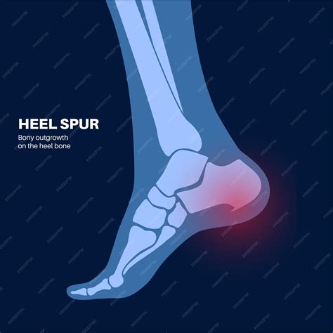 Premium Vector | Calcaneal spur anatomy foot problem diagnostic and