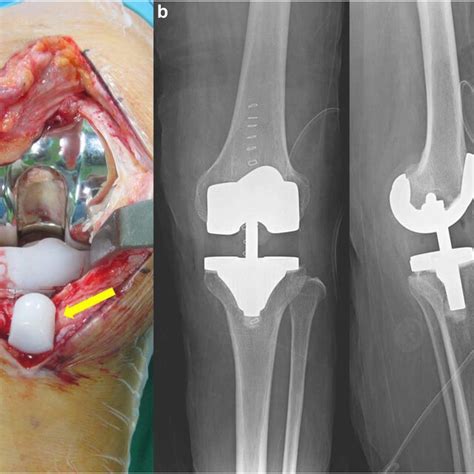 A Patient A Year Old Female Underwent Right Tka With A Mm