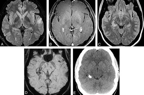 The 2021 World Health Organization Classification Of Tumors Of The