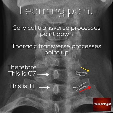 👨🏽‍💻review The Bones Read On For Some Tips On Reviewing Bones On A Chest X Ray ⁣ ⁣ ⁣ 👨🏽‍💻i Do