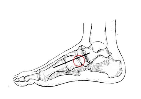 Navicular-Cuneiform Joint Fusion — South West Foot Surgery