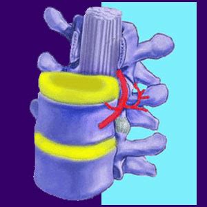 Nerve Compression - Back Pain