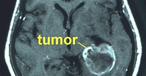 NOTAS CEREBRO 11 TOMOGRAFÍA COMPUTARIZADA MOSTRANDO TUMOR