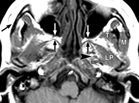 Masticator Space Ct And Mri Of Secondary Tumor Spread Ajr