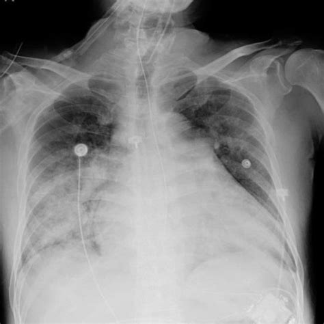 Blood-tinged sputum after receiving second low dose of dabigatran ...