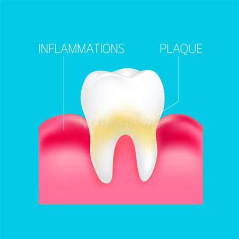 Step Of Periodontal Disease Stock Vector Illustration Of Care