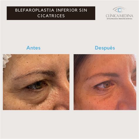 Qué es una Blefaroplastia Blog de Clínica Medina