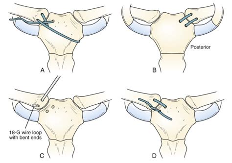 Disorders Of The Sternoclavicular Joint Musculoskeletal Key