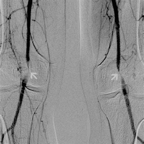 (PDF) MRI and DSA findings in popliteal artery entrapment syndrome