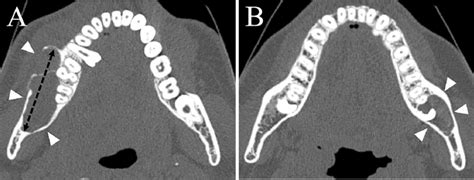 Computed Tomography CT Findings Of Odontogenic Keratocyst OKC A