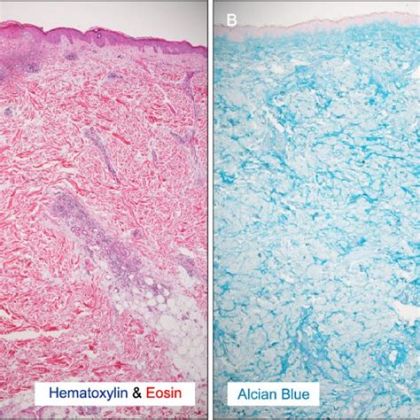 Histological Findings A Focal Epidermal Atrophy And Hydropic