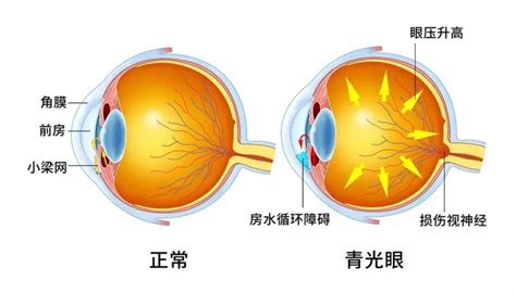 世界青光眼周青光眼致盲不可逆，五大类人群需注意！治疗