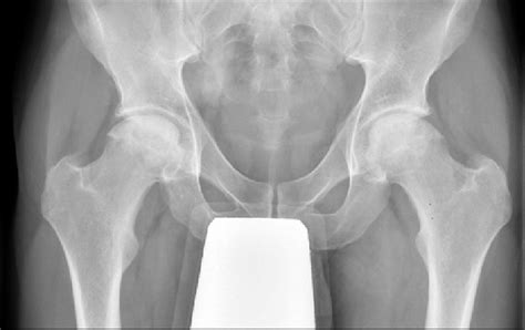 Osteonecrosis Hip X Ray