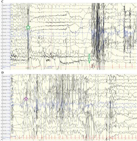 JLE Epileptic Disorders Low Grade Tumour Over The Left Temporal