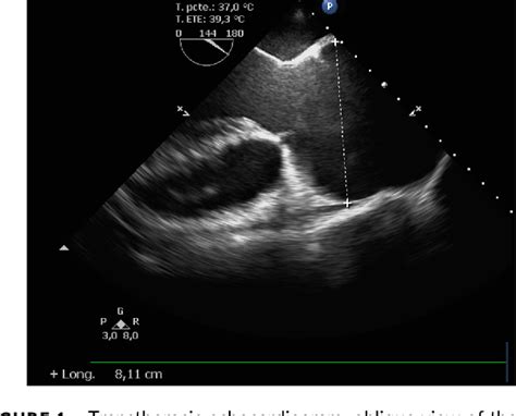 Figure 1 from Giant asymptomatic aortic root aneurysm. | Semantic Scholar