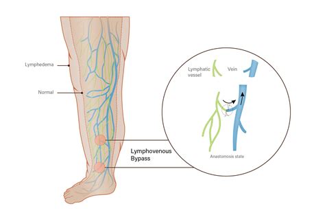 Lymphedema Surgery - Treatment - Siteman Cancer Center