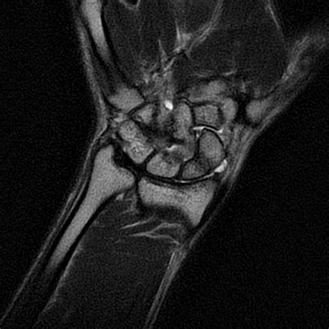 Avascular Necrosis Scaphoid Non Union Image