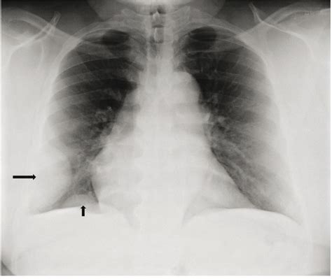 Da li senka u plućima uvek potiče od karcinoma Tumor